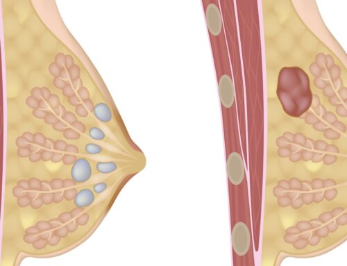 Qual a Diferença entre Cistos e Nódulos nas Mamas?