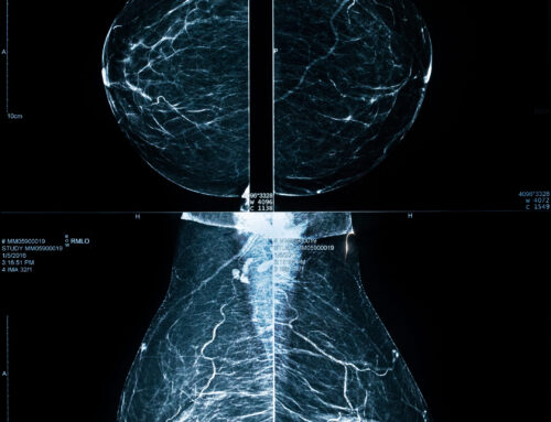 Mamas Densas: O Que São, Como São Diagnosticadas e o Risco de Câncer de Mama
