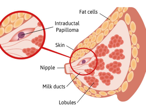 Papiloma Intraductal na Mama: O Que Você Precisa Saber