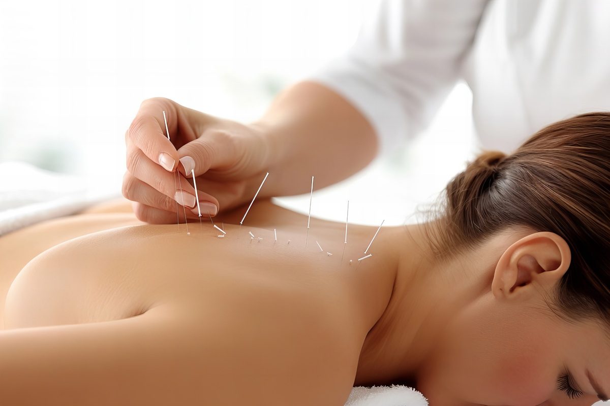 Mulher recebendo acupuntura e massagem para alívio da dor em cuidados paliativos do câncer de mama.