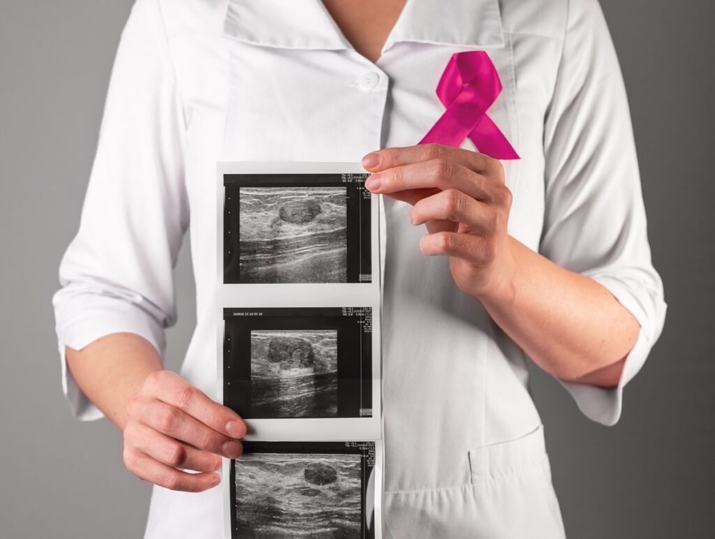 Médico analisando ultrassom de mama mostrando nódulo benigno durante exame preventivo