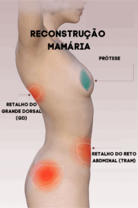 Reconstrução mamária com tecido próprio: retalho TRAM abdominal vs. retalho do músculo grande dorsal