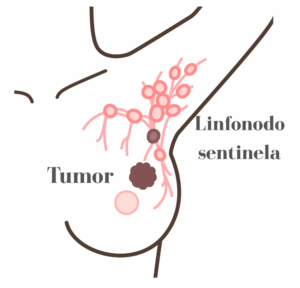 Técnica de biópsia do linfonodo sentinela em cirurgia de câncer de mama