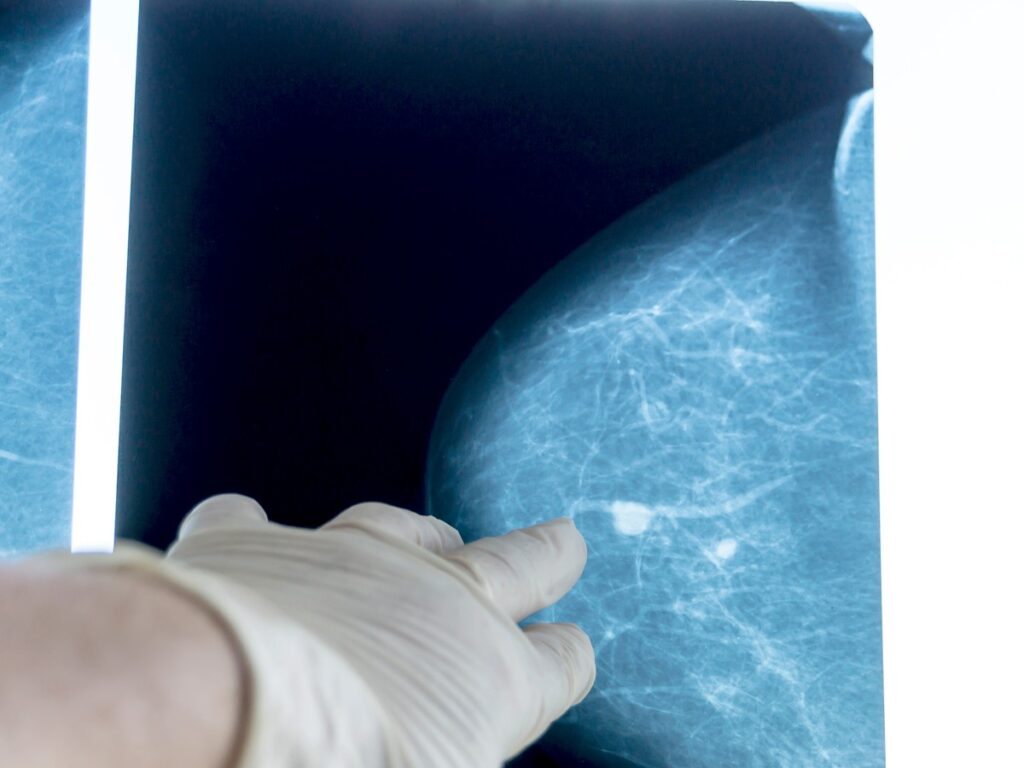 Médico explicando resultado de mamografia com macrocalcificação para paciente