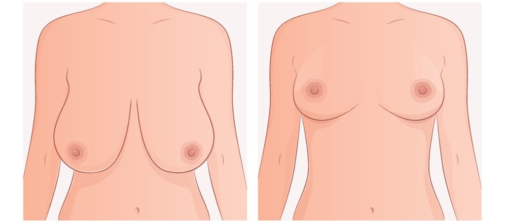 Comparação antes/depois de mastopexia redutora: correção de ptose mamária