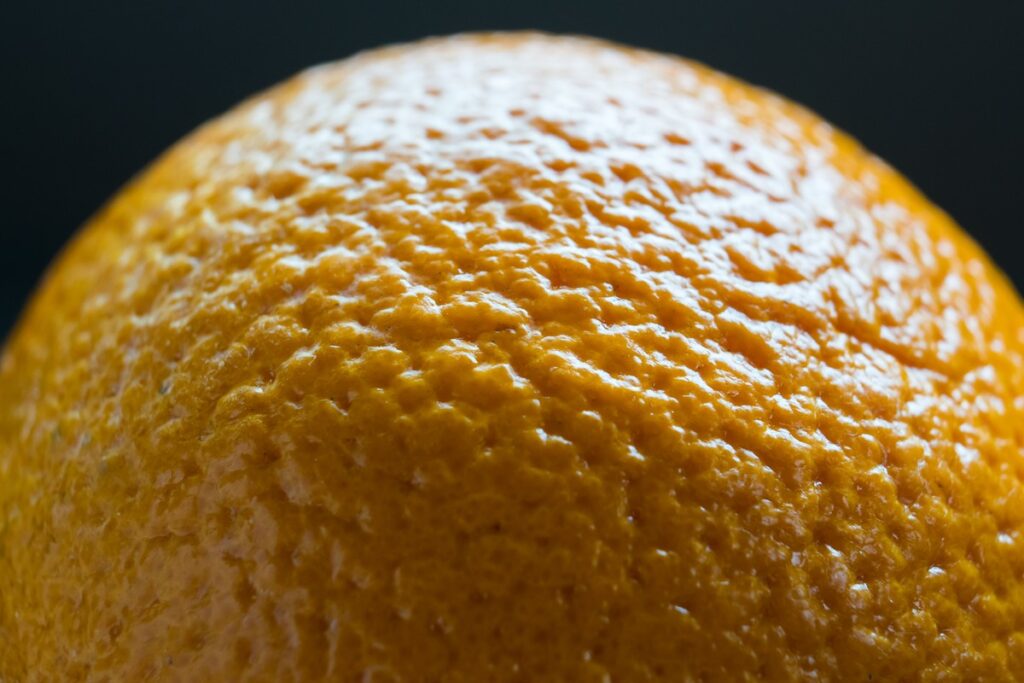 Pele da mama com textura de casca de laranja (peau d'orange), sintoma clássico do carcinoma inflamatório
