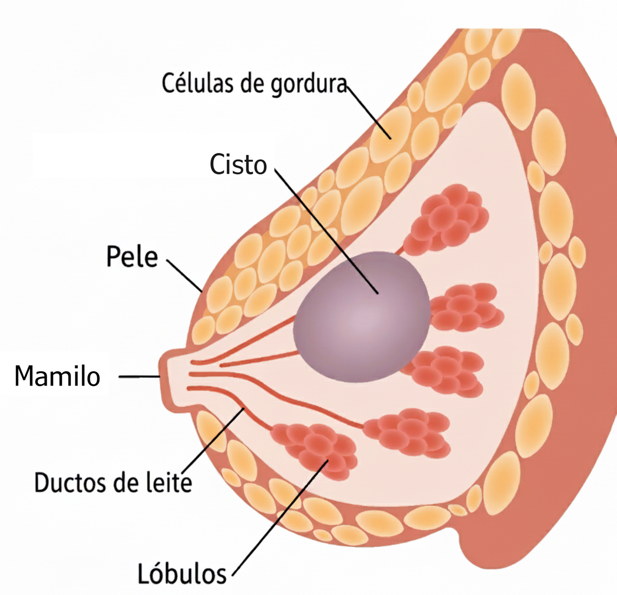 Ilustração médica detalhada de um cisto mamário grande preenchido por líquido, localizado entre os lóbulos da mama.