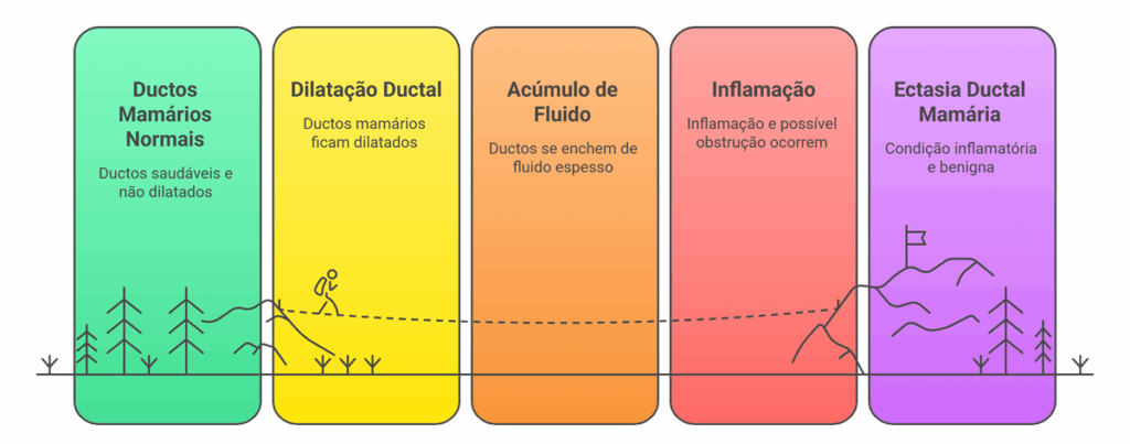 Fluxograma explicativo sobre o que é Ectasia Ductal Mamária, mostrando a progressão de ductos mamários saudáveis para a dilatação, acúmulo de fluido e inflamação, resultando na condição benigna.