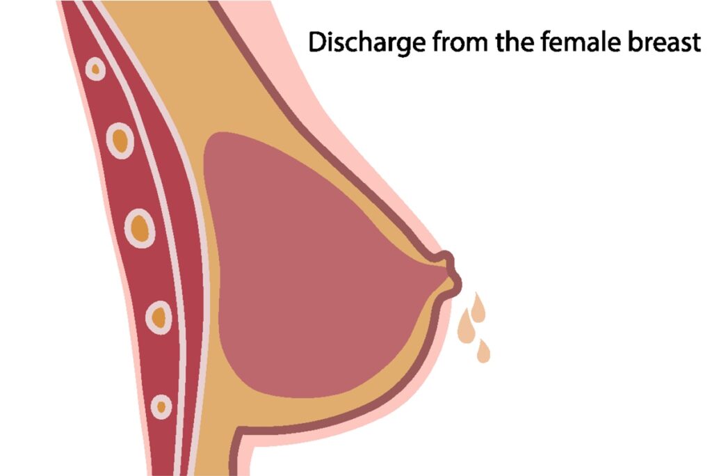 Ilustração médica mostrando secreção saindo do mamilo feminino, um dos sintomas comuns da Ectasia Ductal Mamária.